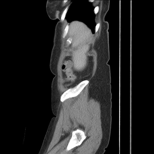 Bilateral adrenal granulocytic sarcomas (chloromas) (Radiopaedia 78375-91007 C 27).jpg
