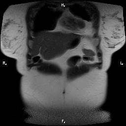 File:Bilateral adrenal myelolipoma (Radiopaedia 63058-71537 Coronal T2 30).jpg