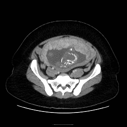 Bilateral adrenal thrombosis (Radiopaedia 58182-65256 A 57).jpg