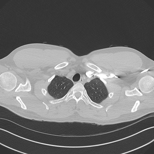 Bilateral atelectasis (Radiopaedia 48666-53675 Axial lung window 9).jpg