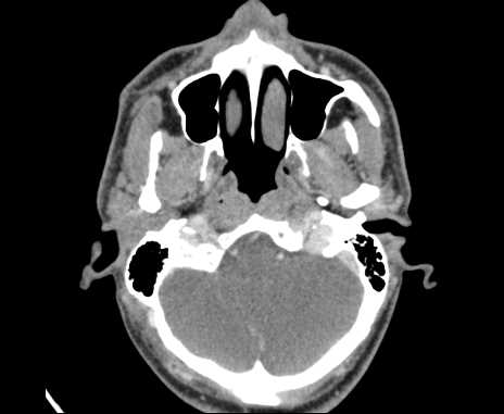 File:Bilateral carotid body tumors (Radiopaedia 61841-69870 Axial Post contrast 8).jpg