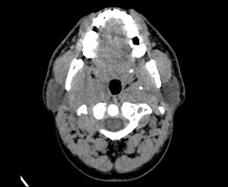 File:Bilateral carotid body tumors (Radiopaedia 61841-69870 Axial non-contrast 25).jpg