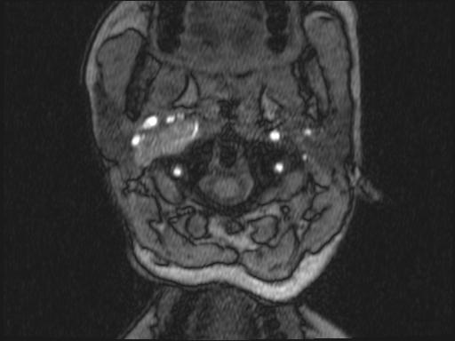 Bilateral carotid body tumors and right glomus jugulare tumor (Radiopaedia 20024-20060 Axial MRA 286).jpg