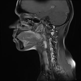 File:Bilateral carotid body tumors and right jugular paraganglioma (Radiopaedia 20024-20060 Sagittal 13).jpg