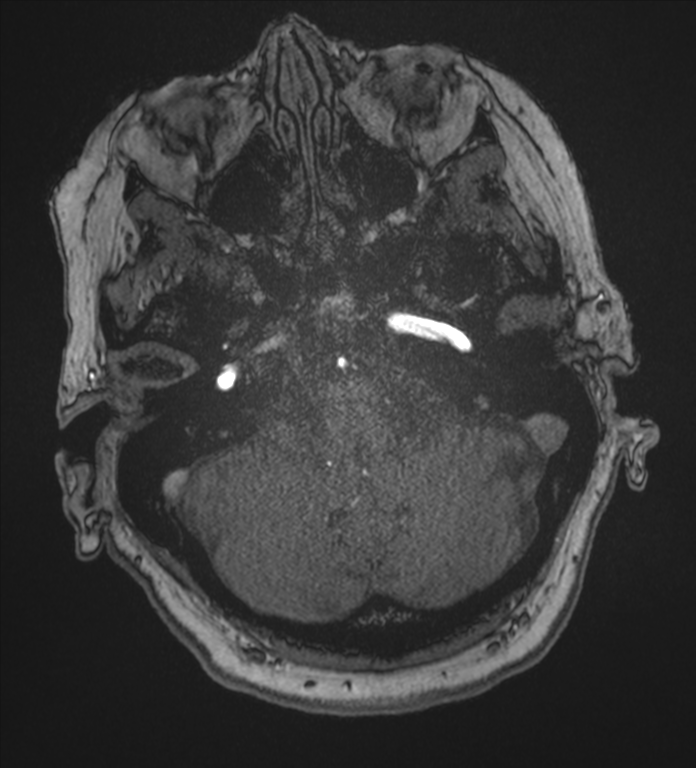 Bilateral fetal posterior communicating arteries (Radiopaedia 41286-44102 Axial MRA 29).png