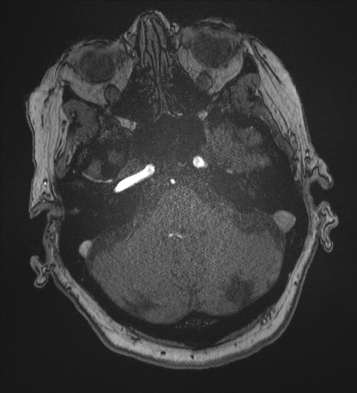 Bilateral fetal posterior communicating arteries (Radiopaedia 41286-44102 Axial MRA 37).png