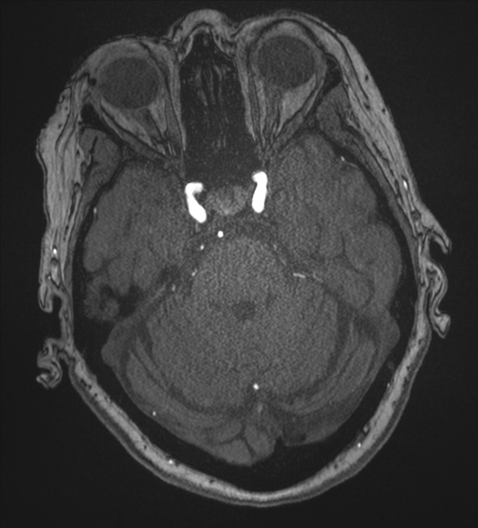 Bilateral fetal posterior communicating arteries (Radiopaedia 41286-44102 Axial MRA 59).png