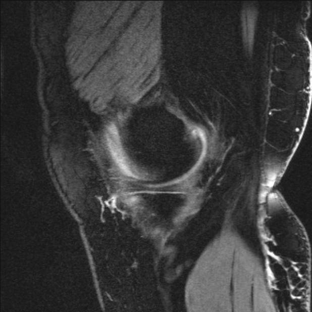 Bilateral focal pigmented villonodular synovitis (Radiopaedia 67643-77046 G 12).jpg
