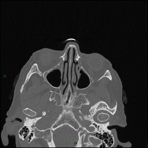 File:Bilateral frontal mucoceles (Radiopaedia 82352-96454 Axial bone window 172).jpg