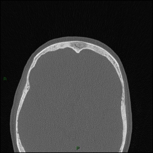 File:Bilateral frontal mucoceles (Radiopaedia 82352-96454 Axial bone window 76).jpg