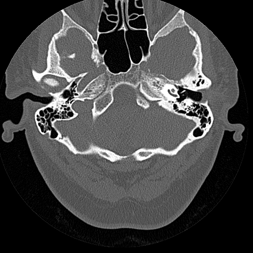 File:Bilateral ossifications of the external auditory canal (Radiopaedia 15233-15076 Axial bone window 12).jpg