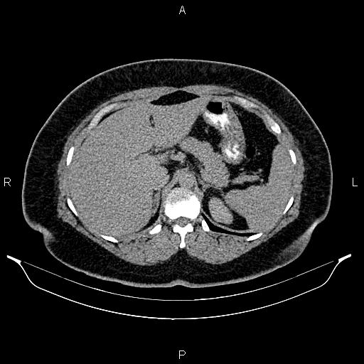 Bilateral ovarian dermoid cysts (Radiopaedia 85785-101603 Axial C+ delayed 14).jpg