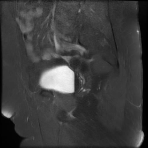 File:Bilateral ovarian dermoid cysts (Radiopaedia 90152-107338 Sagittal T1 C+ 7).jpg
