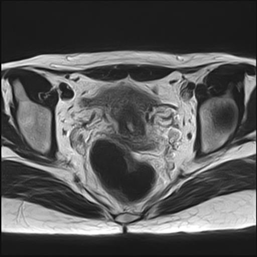 File:Bilateral ovarian endometriomas (Radiopaedia 87085-103347 Axial T2 13).jpg