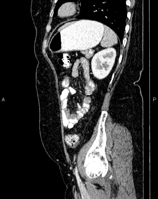 Bilateral ovarian serous cystadenocarcinoma (Radiopaedia 86062-101989 E 67).jpg