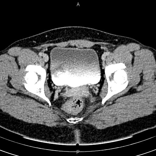 File:Bilateral ovarian teratoma (Radiopaedia 83131-97503 B 62).jpg