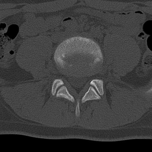 Bilateral pars defect (Radiopaedia 26691-26846 Axial bone window 41).jpg
