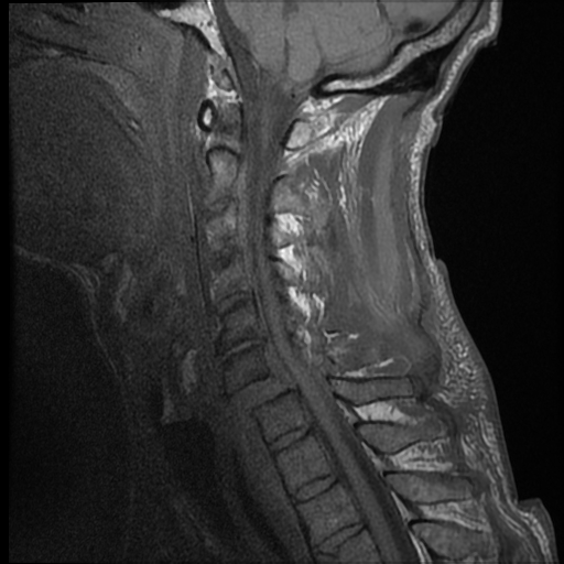 File:Bilateral perched facets with cord injury (Radiopaedia 45587-49714 Sagittal T1 6).jpg