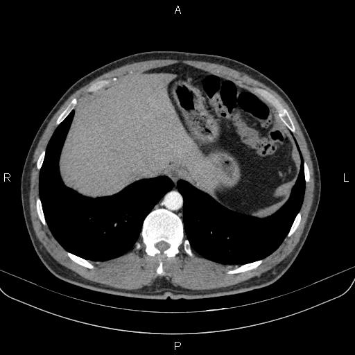Bilateral pulmonary AVM (Radiopaedia 83134-97505 A 63).jpg