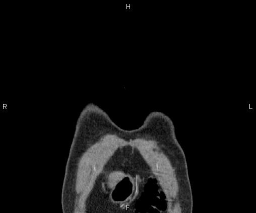 Bilateral pulmonary AVM (Radiopaedia 83134-97505 C 2).jpg