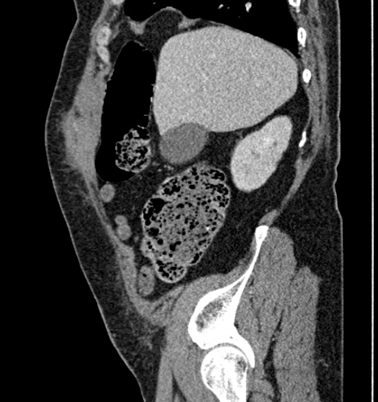 Bilateral rectus sheath hematomas (Radiopaedia 50778-56252 B 20).jpg