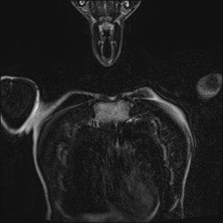 Bilateral spinoglenoid notch ganglion cysts (Radiopaedia 29577-30082 Coronal T2 15).jpg