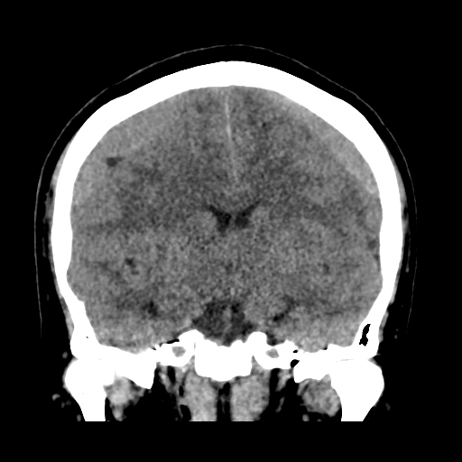 Bilateral subacute subdural hematoma (Radiopaedia 69240-79018 Coronal non-contrast 28).jpg