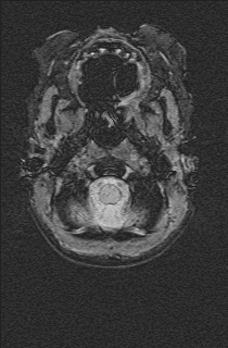 File:Bilateral subdural hemorrhage and parietal skull fracture (Radiopaedia 26058-26190 Axial SWI 3).png
