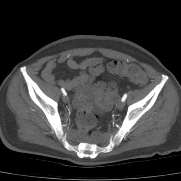 Bilateral superficial femoral arterial occlusion (Radiopaedia 25682-25857 A 21).jpg