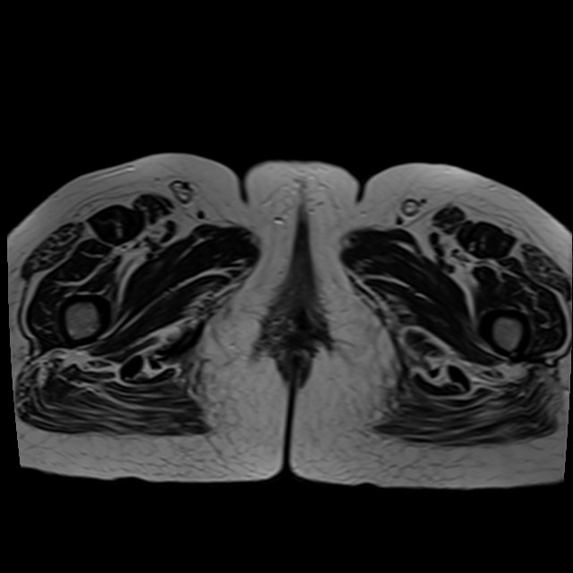 Bilateral tubo-ovarian abscesses (Radiopaedia 58635-65829 Axial T2 51).jpg