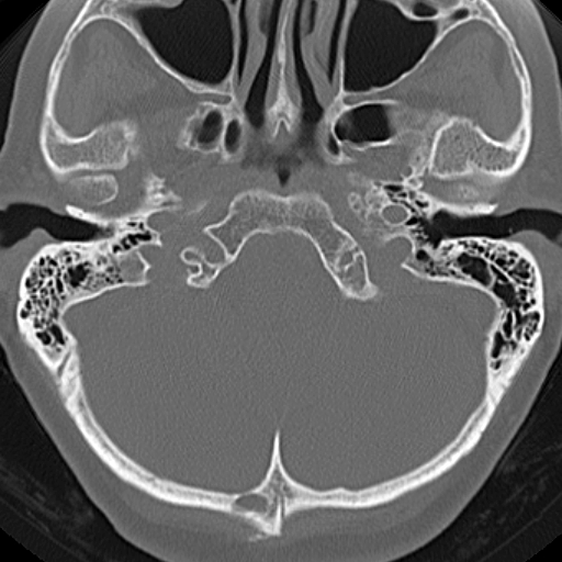 File:Bilateral tympanoplasty (Radiopaedia 16947-16664 Axial bone window 21).jpg