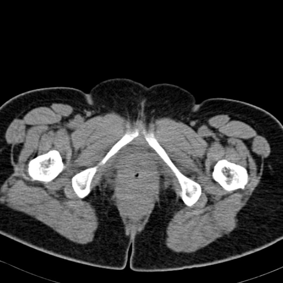 Bilateral ureteric stents (Radiopaedia 48795-53825 Axial non-contrast 73).jpg