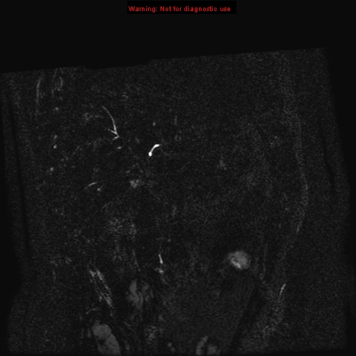 Biliary tree anatomical variant - biliary trifurcation (Radiopaedia 12531-12750 C 58).jpg