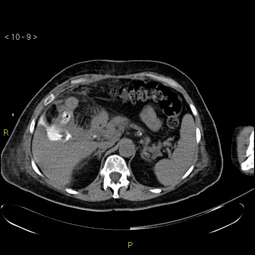 File:Biloma with drainage into the colon (Radiopaedia 20032-20068 B 9).jpg