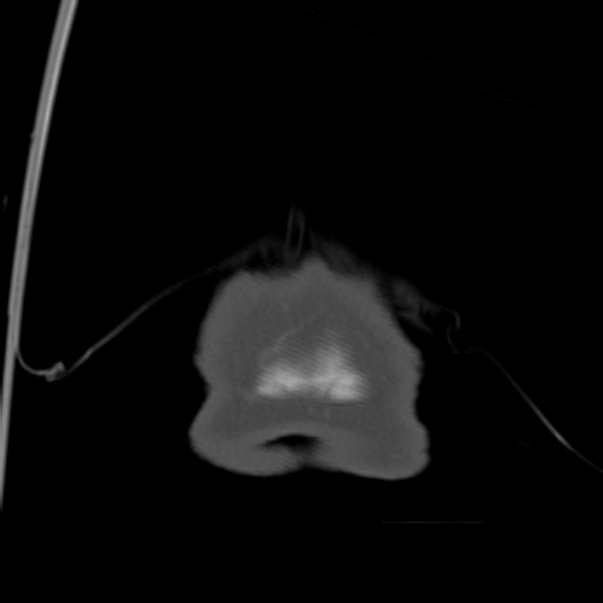 Biparietal osteodystrophy (Radiopaedia 46109-50463 Coronal bone window 108).jpg