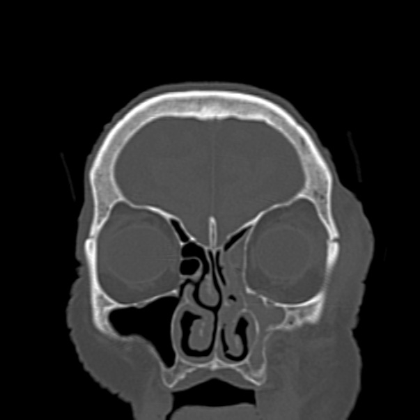 Biparietal osteodystrophy (Radiopaedia 46109-50463 Coronal bone window 24).jpg