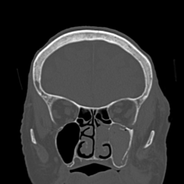 Biparietal osteodystrophy (Radiopaedia 46109-50463 Coronal bone window 32).jpg
