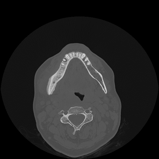 File:Bisphosphonate-related osteonecrosis of the jaw (Radiopaedia 71324-81642 Axial bone window 55).jpg