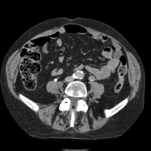 Bladder tumor detected on trauma CT (Radiopaedia 51809-57609 C 83).jpg