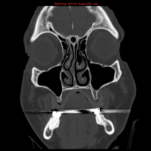 File:Blowout fracture with inferior rectus entrapment (Radiopaedia 12418-12673 Coronal bone window 2).jpg