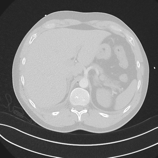 File:Boerhaave syndrome (Radiopaedia 39382-41660 Axial lung window 56).png