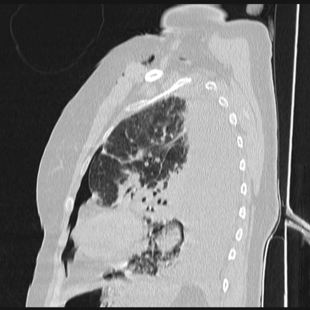 Boerhaave syndrome (Radiopaedia 45644-49799 Sagittal lung window 61).jpg