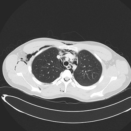 Boerhaave syndrome with mediastinal, axillary, neck and epidural free gas (Radiopaedia 41297-44115 Axial lung window 37).jpg