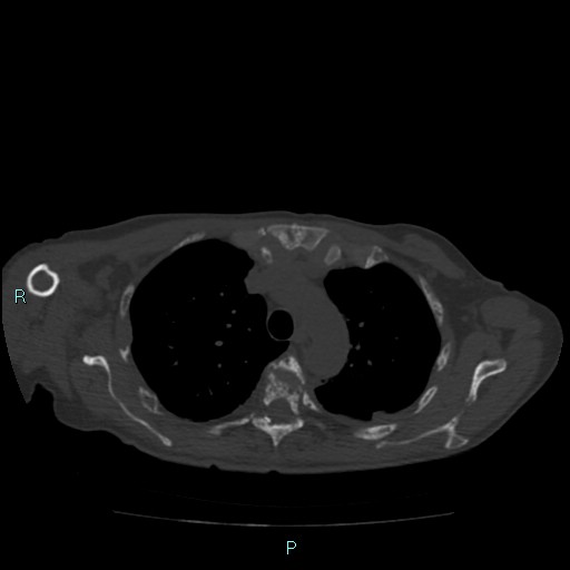 Bone metastases from untreated breast cancer (Radiopaedia 42973-46219 Axial bone window 29).jpg