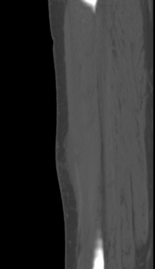 Bone metastasis - tibia (Radiopaedia 57665-64609 Sagittal bone window 123).jpg