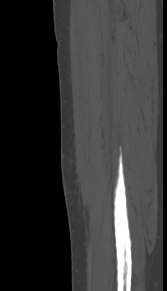 Bone metastasis - tibia (Radiopaedia 57665-64609 Sagittal bone window 146).jpg