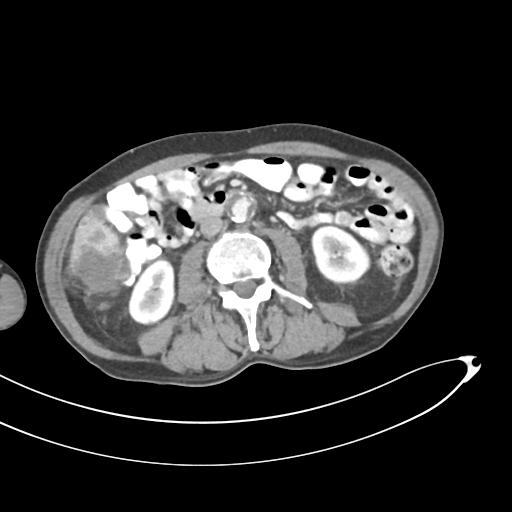 Bone metastasis from squamous cell carcinoma (Radiopaedia 30133-30730 B 37).jpg