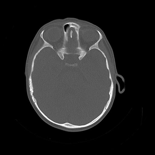 File:Bony atresia of the right external auditory canal (Radiopaedia 27916-28156 Axial bone window 13).jpg