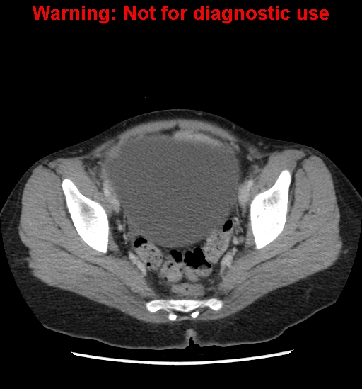 Borderline mucinous cystadenoma of ovary (Radiopaedia 25586-25767 A 98).jpg