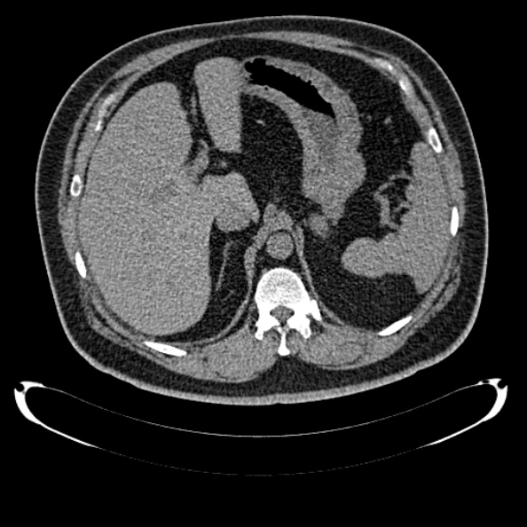 File:Bosniak renal cyst - type IV (Radiopaedia 24244-24518 Axial non-contrast 104).jpg